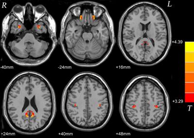 Voxel-Mirrored Homotopic Connectivity of Resting-State Functional Magnetic Resonance Imaging in Blepharospasm